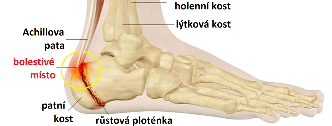 Severova nemoc - bolest paty
